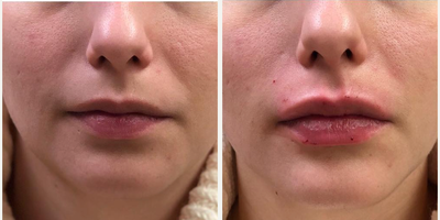 Woman treated with Restylane Lyft, Dermal Fillers - Lip augmentation with Restylane L.