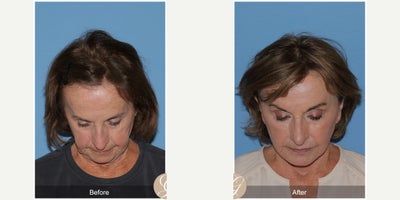 74 year old woman treated with Deep Plane Facelift, Neck Lift, Brow Lift, Lip Lift, MACS Facelift, Facelift - 74 year old woman treated with Deep Plane Face and Neck Lift, Endoscopic Brow Lift, Lip Lift, Full Anterior Face Laser, Fat Grafting, MAC