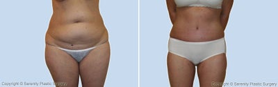 liposuction - liposuction