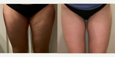 45-54 year old woman treated with Kybella - Kybella was used for this patient's upper inner thighs. The patient is the same weight in both photos.