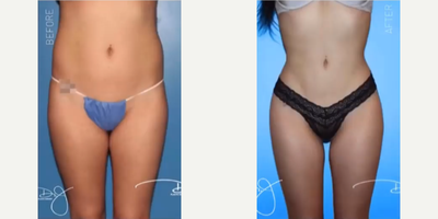 Woman treated with Natural Butt Lift - Woman treated with Natural Butt Lift as well as Lipocontouring