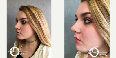 18-24 year old woman treated with Lip Augmentation - lip filler