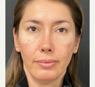 35-44 year old woman treated with Brow Lift - Brow Lift
