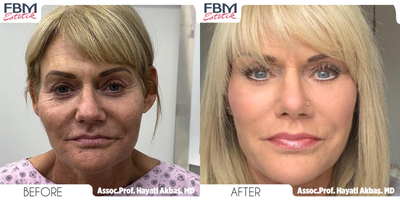 45-54 year old woman treated with Deep Plane Facelift, Neck Lift, Forehead Reduction, Double Eyelid Surgery, Rhinoplasty, Facial - 45-54 year old woman treated with Deep Plane Facelift, Neck Lift, Forehead Reduction, Double Eyelid Surgery, Rhinoplasty, Facial Fat Transfer