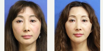 55-64 year old woman treated with Deep Plane Facelift, Facelift, Jaw Reduction, Neck Lift - V line jaw reduction, face and neck lift
