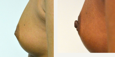 35-44 year old woman treated with Nipple Surgery - A woman in her late 30s who is bothered by inverted nipples. She is a Han and Hong Grade 2. Inverted nipple severity is divided into 3 groups, I, II and III based on the severity of both the inversion and the fibrosis. A grade I nipple can be pulled out easily and maintains the projection easily without traction. A grade II nipple can be pulled out manually but not as easily as a grade I and has difficulty maintaining its position, with a tendency to retract. A grade III is severely inverted and retracted and difficult to pull out manually. Nipple retraction is caused by shortening of the lactiferous ducts. She is shown before and again, 6 weeks after closed inverted nipple treatment with a micro-incision procedure in the office.