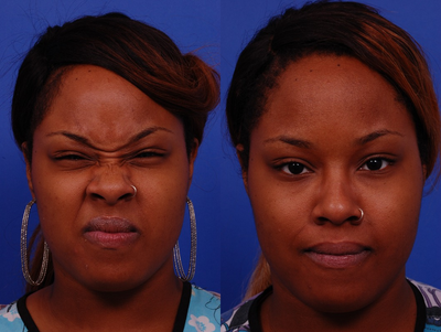 18-24 year old woman treated with Dysport - Treated areas include glabella, crows feet, jelly roll - Dysport treatment on Female -  Treated areas include glabella, crows feet, jelly roll