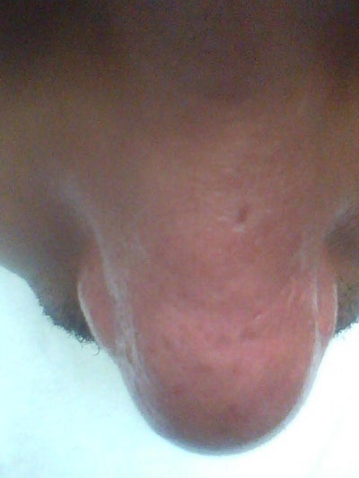 Can coblation laser therapy treat mild rhinophyma in 