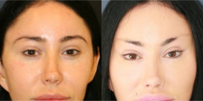 35-44 year old woman treated with Canthoplasty, Eyelid Surgery - Before and two years after Bratz blepharoplasty, Feel Beautiful Plastic Surgery