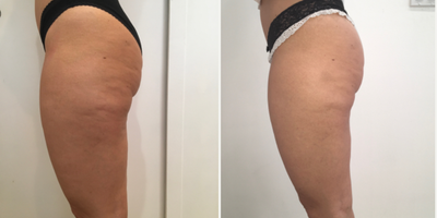 35-44 year old woman treated with Carboxytherapy, Skin Rejuvenation - Woman wanting to get rid of cellulite and tone Lower leg skin and contour hips and inner thighs