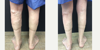 Patient treated with Varithena - Dr. Haney used Varithena, and a phlebectomy to get these great results! The patient felt instant relief from the pain and swelling in his legs after the procedure.