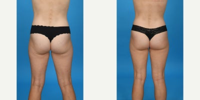 35-44 year old woman treated with Abdominal Etching, Diastasis Recti Repair, Drainless Tummy Tuck, Liposculpture, Liposuction, M - Standard tummy tuck with VASER ultrasound liposuction 360 and corset muscle plication.