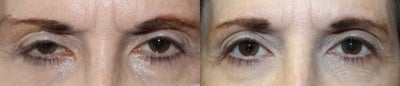 55-64 year old woman treated with Internal Ptosis repair on Right Eye. - 55-64 year old woman treated with Internal Ptosis repair on Right Eye.