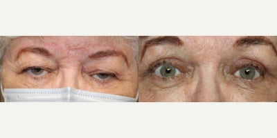 65-74 year old woman treated with Upper Eyelid External Ptosis Repair - 65-74 year old woman treated with Upper Eyelid External Ptosis Repair