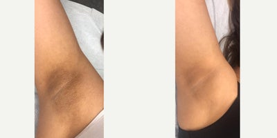 18-24 year old woman treated with Skin Lightening - Underarm Skin BrighteningEnhance the brightness of your underarm skin.