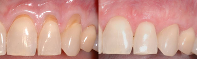 Gum Graft - Case shows severe recession and root surface exposure on a patient. The post operative photo shows the excellent final results after performing a gingival (gum) graft using human allograft (Alloderm) to cover the large amount of area necessary. PT has almost no discomfort because there is no need to take tissue from the palate. Perfect results in both appearance and root coverage