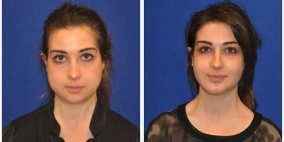 Buccal Fat Removal - Buccal Fat Removal