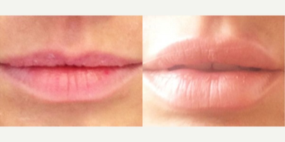 25-34 year old woman treated with Restylane - 1 week after 1 cc Restylane to upper and lower lips. If the natural sub units of the lip and proportions are appreciated and enhanced, the results can look very natural.