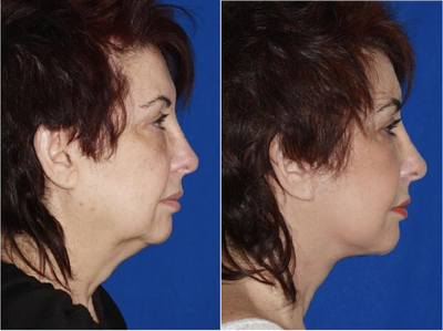 Woman treated with Lower Face Lift - Advanced Facelift