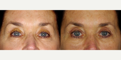 66 year old woman treated with Restylane Refyne - 66 year old woman treated with Restylane Refyne to undereyes. Photos depict before and 2 months after treatment.