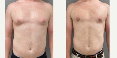 25-34 year old man treated with Gynecomastia Surgery - 34 yo male s/p liposuction and gland excision treatment of gynecomastia performed under local anesthesia with sedation in our on site AAAA certified operating suite.