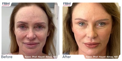 45-54 year old woman treated with Deep Plane Facelift - 45-54 year old woman treated with Deep Plane Facelift