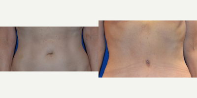 Recreation of belly button during tummy tuck - Recreation of belly button during tummy tuck