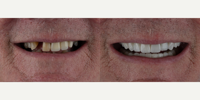 55-64 year old man treated with Dental Implants - Full mouth rehabilitation of the upper and lower jaw. An optimal bite was achieved where the patient can now comfortably chew and function.