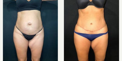 35-44 year old woman treated with Tummy Tuck, Umbilical Hernia Repair - The patient is a 39-year-old female who had concerns with her abdominal pannus and umbilical hernia after having children. The procedure performed was an abdominoplasty with umbilical hernia repair. The photos show 15 months post-op.