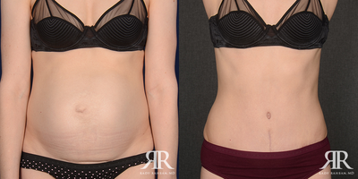 Woman treated with Tummy Tuck - Woman treated with Tummy Tuck