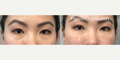 Woman treated with Dermal Fillers, Hyaluronidase, Sculptra - Woman treated with Dermal Fillers, Hyaluronidase, Sculptra