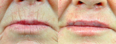 55-64 year old woman treated with Volbella - Volbella