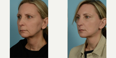 45-54 year old woman treated with Facelift, Lower Facelift, Neck Lift, Facial Fat Transfer, Laser Resurfacing, Dermabrasion - The 54-year-old female patient pictured above was driven by considerable changes of aging, particularly evident in the areas around the jowls and cheeks, thin lips, the early appearance of vertical lines around the mouth, and changes in her neck. This active runner and yoga enthusiast sought out the exceptional Facelift/Minilift by Dr. Mustoe in Chicago, renowned for delivering natural and not overstretched results. The patient was referred by a friend who ten years prior had trusted Dr. Mustoe with a similar surgery.Under IV sedation and local anesthesia, Dr. Mustoe employed a deep plane facelift, fat grafting around the mouth, ablative laser, and spot dermabrasion around the mouth and to her forehead. Her ease throughout the process was likely a result of the widely recognized expertise and care of Dr. Mustoe and his staff at TLKM Plastic Surgery.Post-procedure, the patient's results were dramatically visible in her naturally rejuvenated and fresh appearance. The transformation was balanced, avoiding the appearance of being overstretched, which was crucial for her. Comfort and satisfaction with the Facelift/Minilift by Dr. Mustoe in Chicago was evident in the patient's glowing post-procedure expression, all while retaining the natural characteristics that made her unique. The outcomes bear witness to Dr. Mustoe's excellence, a culmination of over 30 years of experience combined with a prestigious background of education and research from Harvard to advisory positions with the U.S. Food & Drug Administration.