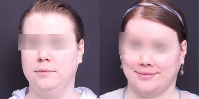25-34 year old transgender woman treated with Facial Feminization Surgery - AFG to face, browlift, brow bone reduction, hairline advancement, rhinoplasty, lip lift with augmentation, buccal fat pad, mandible/chin contouring, sliding genioplasty, face lift, submental liposuction