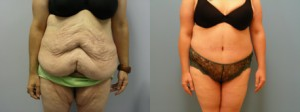 Woman treated with Liposuction - Woman treated with Liposuction