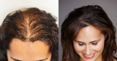 25-34 year old woman treated with Scalp Micropigmentation - Scalp Micropigmentation
