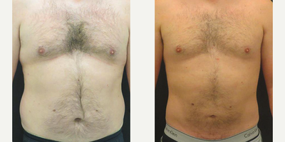 Male Tummy Tuck - Patient has undergone abdominoplasty with diastasis recti repair, liposuction to hips and flanks, and pubic lift.