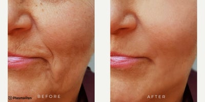Woman treated with PlasmaPen - Woman treated with PlasmaPen