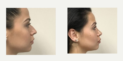 25-34 year old woman treated with Rhinoplasty - 28 year old female shown before and six weeks after an open rhinoplasty. The dorsum (top) of the nose has a decreased hump and the tip has more projection.