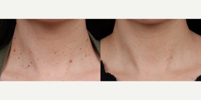 35-44 year old woman treated with Mole Removal - 3 weeks post snip excision, 3 months post BBL (BroadBand Light)