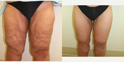 35-44 year old woman treated with Thigh Lift - 40 year old female status post thigh lift