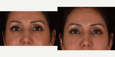 New & Innovative approach to Hyaluronic Acid Injectables - Results demonstrate before and immediate afters for under eye circle treatment. Now instead of solely injecting dermal fillers for volume loss, Dr. Kian has started the newest, most innovative approach, as he likes to describe cutting edge treatment for injectable fillers. This treatment formula now includes the addition of platelet rich fibrin (PRF) into the mix. PRF is the newest generation of PRP (platelet rich plasma) and contains platelets, fibrin, and a small concentrations of stem cells. The added benefits of PRF include greater volume enhancement, as the solution turns into a gel-like substance, and promotion of collagen production and stimulation, in turn improving overall skin quality with time. In addition to these benefits for correcting volume depleted areas and promoting skin rejuvenation, the treatment is done by the use of a micro-cannula (blunt tip instrument) essentially eliminating any chances for bruising.