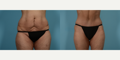 55-64 year old woman treated with Tummy Tuck - 59 year old woman 2 years post op