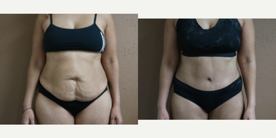 35-44 year old gender nonconforming person treated with Tummy Tuck - 6 months post abdominoplasty with liposuction