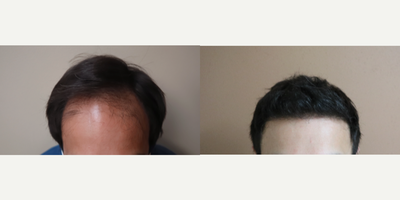 25-34 year old man treated with FUE Hair Transplant - 10 months following FUE Hair Transplant, 3000 grafts