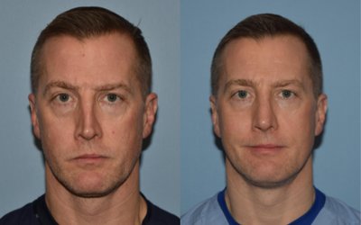 45-54 year old man treated with Rhinoplasty - Reconstructive septorhinoplasty with cartilage graft.
