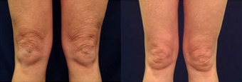 Body Laser Skin Tightening - Legs - Laser Skin Tightening Legs, Body Laser Skin Tightening - Performed by Raleigh Plastic Surgeon Michael Law MD