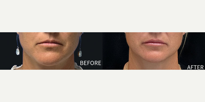 Woman treated with Lip Fillers - Woman treated with Lip Fillers