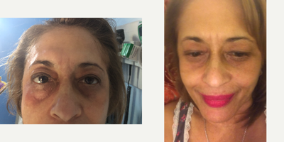 55-64 year old woman treated with Skin Tightening - Before and after 2 sessions of TempSure 4 weeks apart .You can see the under eyes skin is tighter and smoother, the darkness is less . The patient will require 2 more treatments and then will consider dermal fillers for thebunder eye areas .
