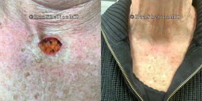 65-74 year old woman treated with Mohs Surgery - 70 year old woman treated with Mohs surgery on the chest